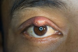 a stye on the lower eyelid