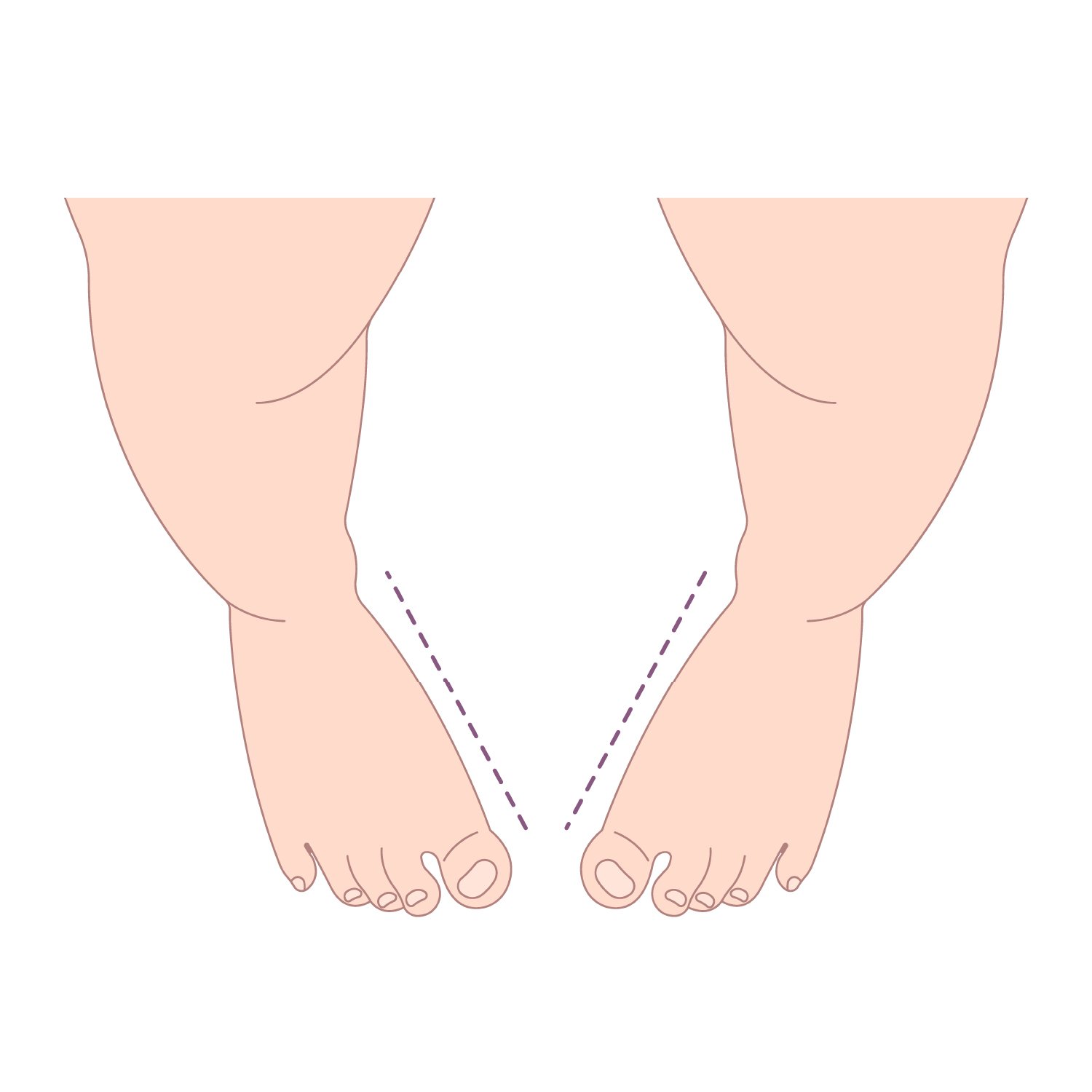 In-toeing and out-toeing