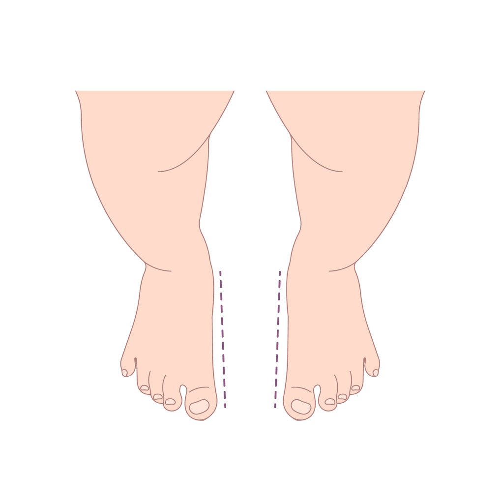 In-toeing and out-toeing