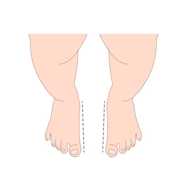 Toe Layout In-toeing and out-toeing