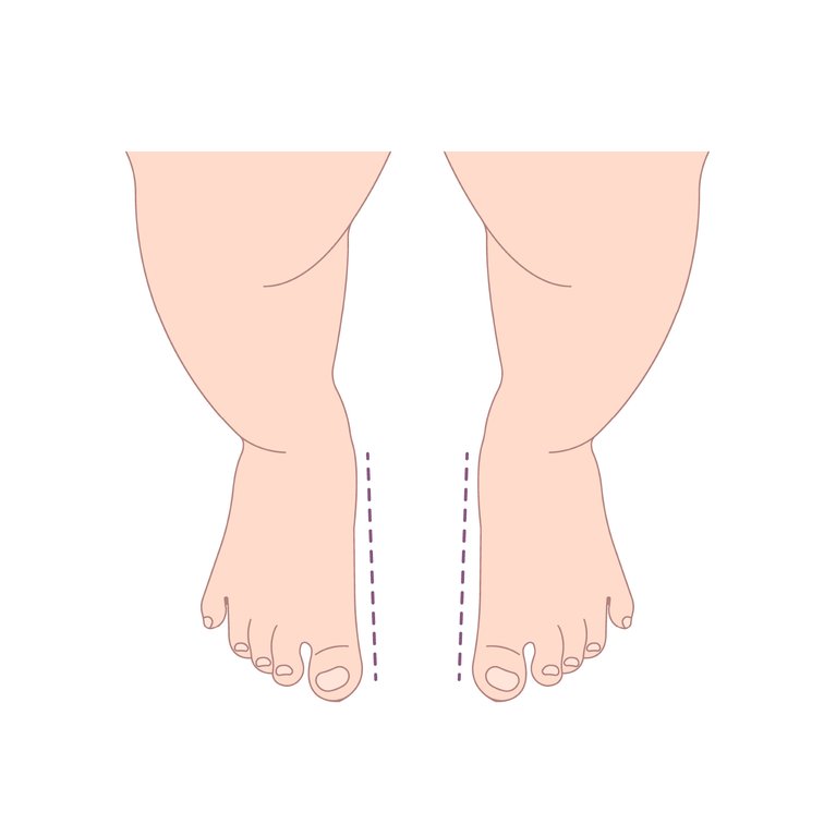 Toe In Example In-toeing and out-toeing