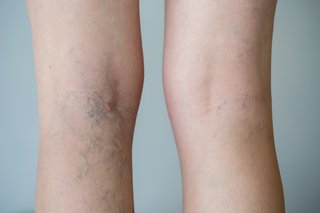 Image showing varicose veins on the back of a woman's legs.