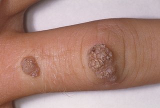 Two raised oval-shaped warts with a rough texture shown on a finger with white skin.