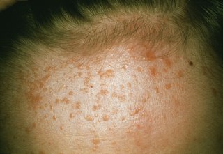 A cluster of yellow plane warts spread across a forehead, shown on white skin.