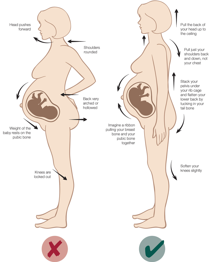 Correct posture in pregnancy can help to improve back pain