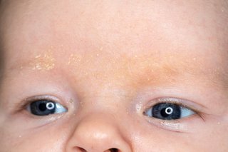 close up of babies forehead with build up of dry skin