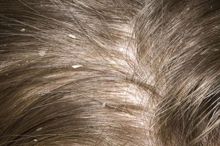 Close up of white dandruff flakes on light brown hair