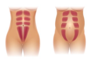 Two illustrated figures showing the six pack muscle. One figure shows a normal abdomen (tummy) and the other figure shows a diastasis recti through the middle of the tummy.