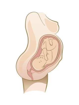 Illustration of baby in Occipito anterior position