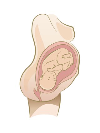 Illustration of baby in Occipito posterior position