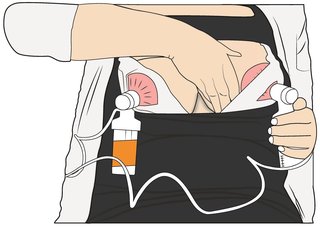 Illustration of a woman using a breast pump. The pump is attached to both breasts. She is applying pressure to one breast with her hand.