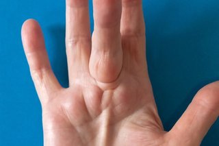 The palm of a hand with white skin held out flat with the middle finger sticking upwards and raised lumps along the palm below it.