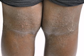 backs of the knees of a person with brown skin and inflamed skin that is grey