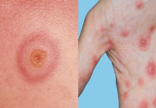 stevens johnson syndrome mild rash