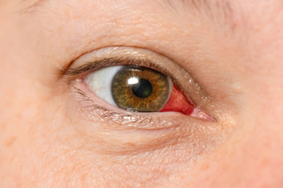 A bright red area in the inner corner of the white of an eye.