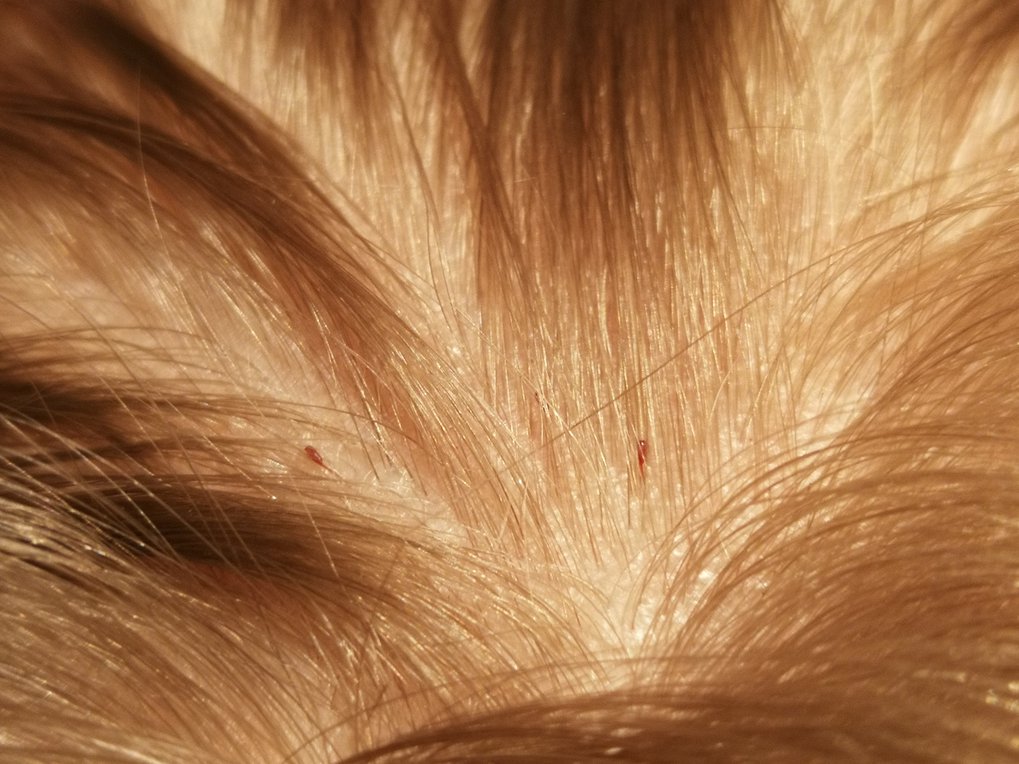 Head Lice And Nits HSE ie