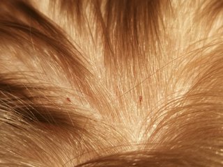 Head lice removing from brown hair  How to clear out all head lice   YouTube