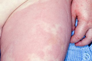 Hives or urticaria in children & teenagers