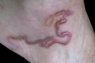 A large, dark pink hookworm underneath a person's skin