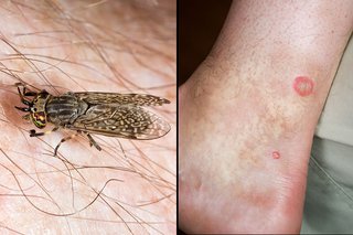 A side-by-side image of a small winged horsefly (left) and a horsefly bite shown on white skin. There is a round red area where the skin was bitten.
