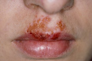 Picture of sores above lips