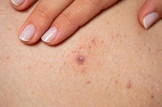 White skin with an infected ingrown hair with pus in the centre of the spot