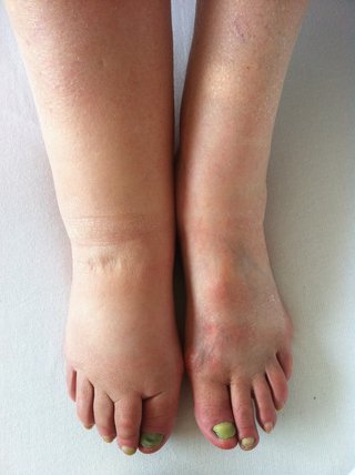 Close up of feet and lower legs. One of the legs has swelling caused by lymphoedema