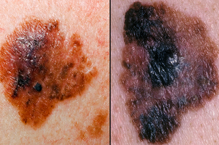 2 images side by side showing brown melanomas on white skin with notched or raggedborder