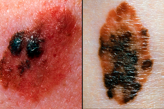 2 images side by side each showing how melanomas have a mix of 2 or more coloirs. One is pink and black, 1 is brown and black.