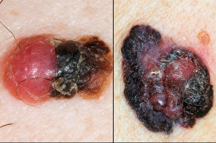 Skin Cancer Melanoma Symptoms Hse Ie