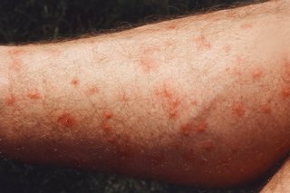 Mite bites shown on white skin. There are small red lumps where the skin was bitten.