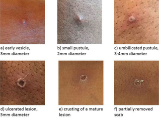 image of progression of monkeypox blister. 1 early vesicle 3 millimetres in diameter, 2 small pustule 2 millimetres in diameter, 3 umbilicated pustule 3 to 4 millimetres in diameter, 4 ulcerated lesion 5 millimetres in diameter, 5 crusting of a mature lesion, 6 partially removed scab