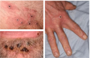 images of monkeypox blisters on skin, hairline and hand
