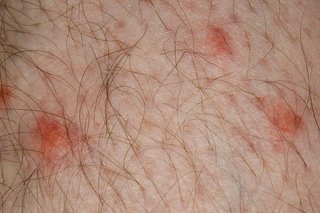 Close up of mosquito bites on white skin
