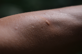 A mosquito bite shown on brown skin. There is a small raised lump where the skin was bitten.
