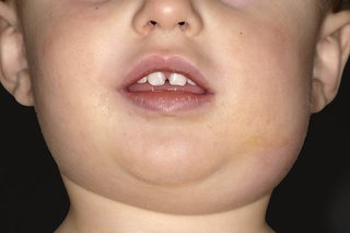 A child with a swollen face caused by mumps