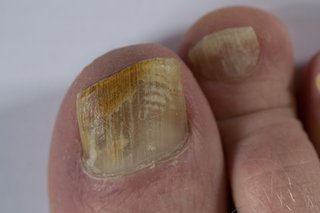 Nail problems - NHS