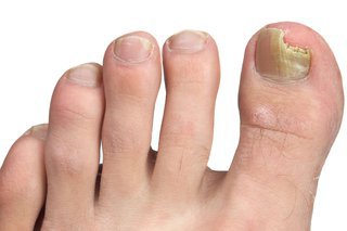 The nail on a person's big toe is yellow and crumbling. Part of the big toe nail has broken off.