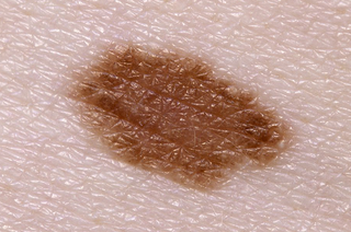 A slightly elevated soft skin-colored patch of irregular shape and