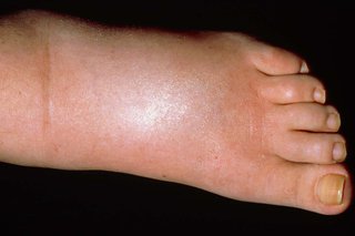 When to See a Doctor for Swollen Feet Treatment