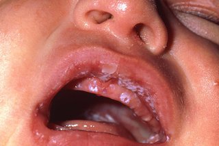 Close up of a baby's open mouth. There are white spots inside the lips and mouth.