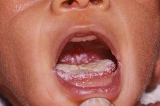 Close up of a baby's open mouth. A white coating covers the tongue. There are white spots at the back of the mouth.