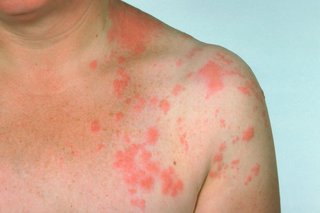 chest and shoulder of person with red blotches on white skin, on one side of their body only