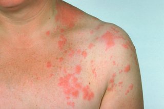 Shingles Under the Breast: Signs and Treatment