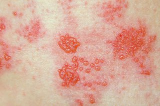 Red shingles blisters on white skin