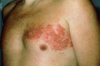Man's torso with a band of shingles rash on one side