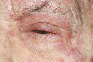 Shingles rash around an eye