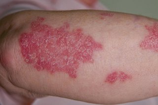 Dry red skin lesions with silver scales on white skin
