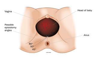 How an episiotomy is performed HSE.ie