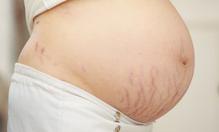 stretch marks on pregnant tummy